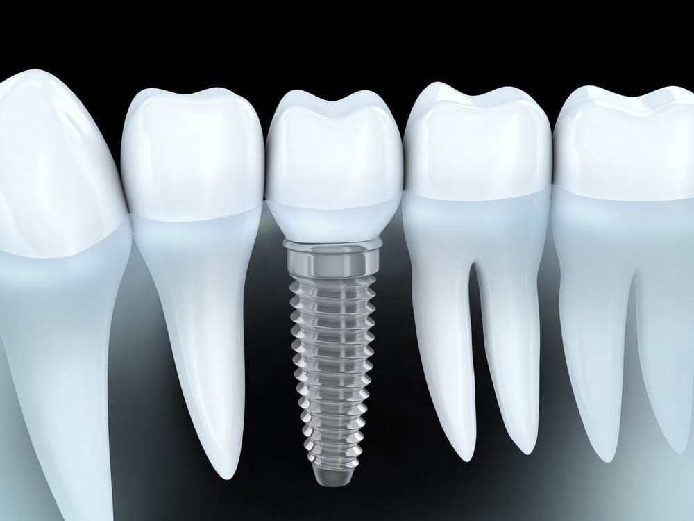 Dental Implants in Ottawa, ON