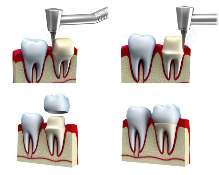 4 image diagram of a tooth being drilled and re-crowned