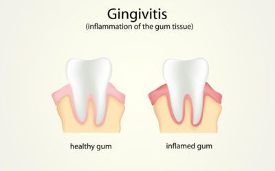 Gingivitis & Periodontitis