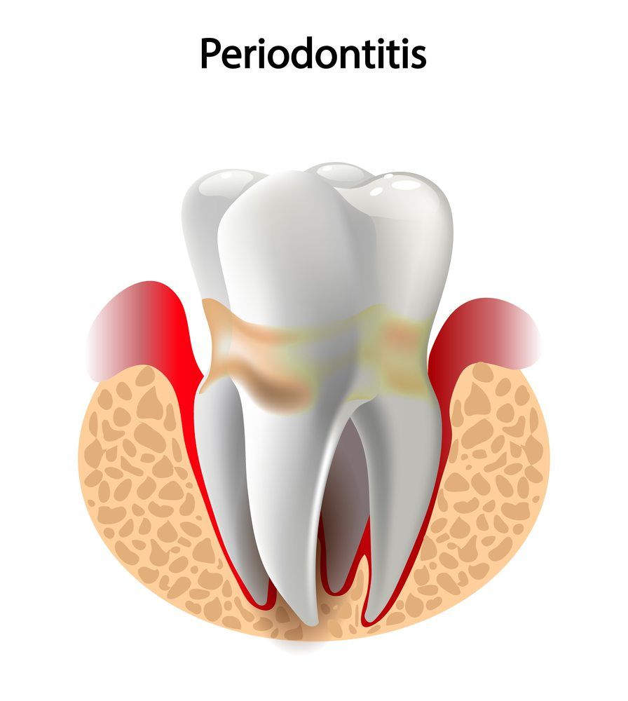 types-of-periodontal-disease-dental-clinic-in-ottawa-on-kent