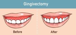 gingivectomy